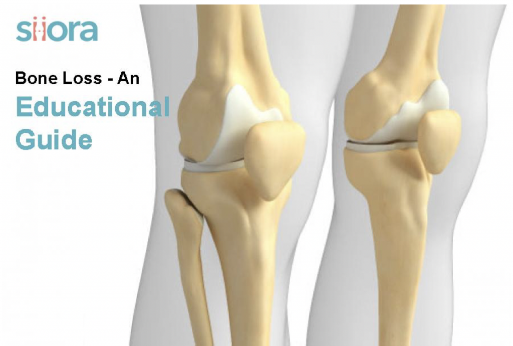 Bone Loss An Educational GuideOnya Magazine